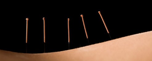 WHO IS MEDICAL ACUPUNCTURE SUITABLE FOR?
